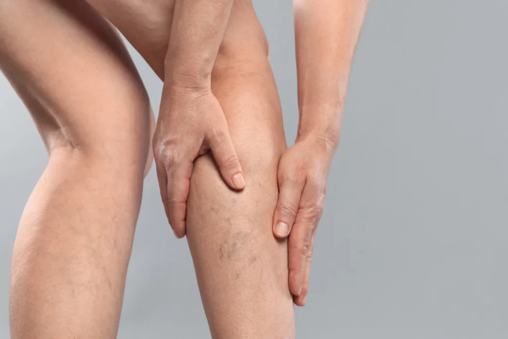 Tipos de varices