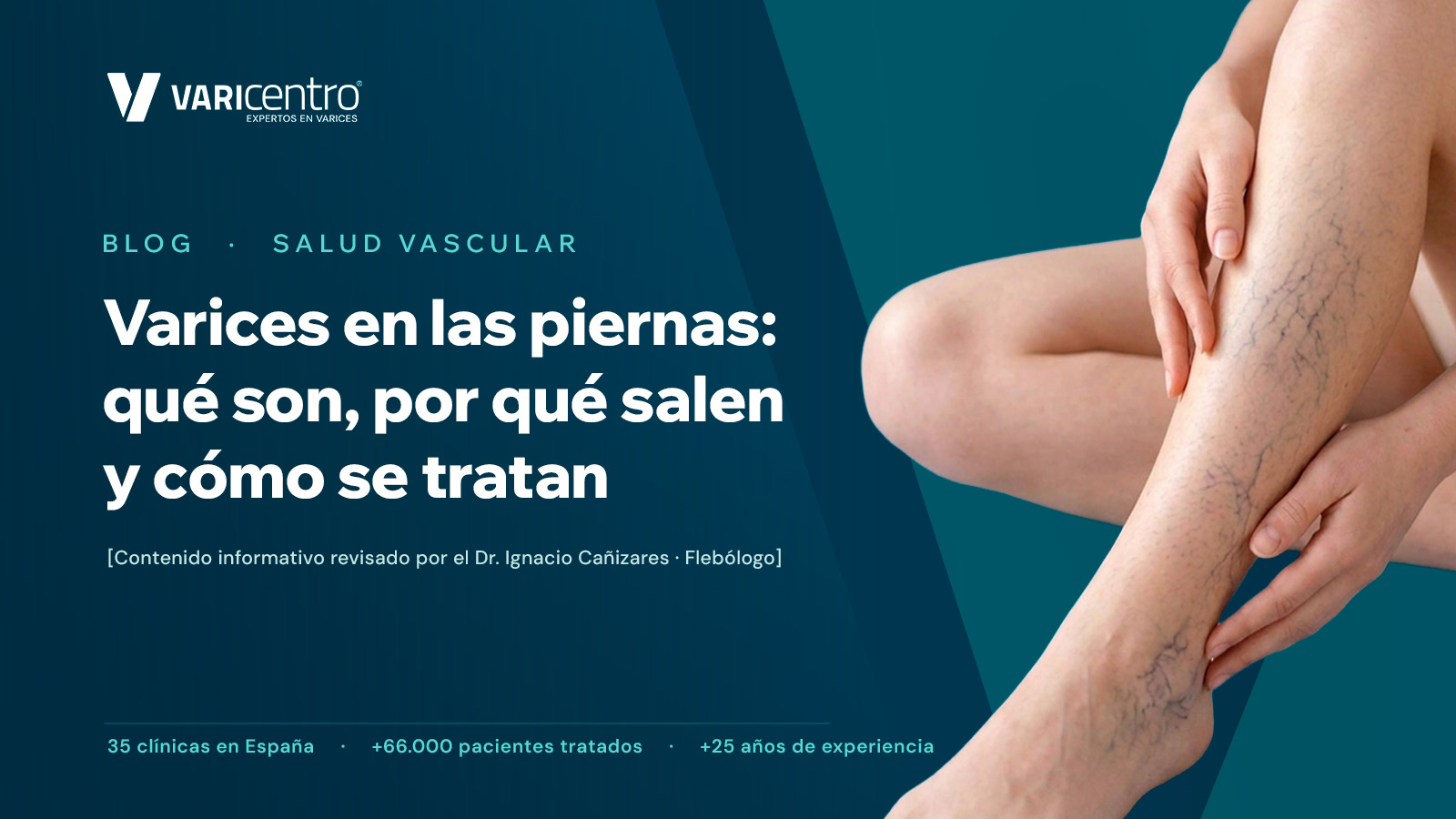 Varices en las piernas: qué son, por qué salen y cómo se tratan – VARIcentro