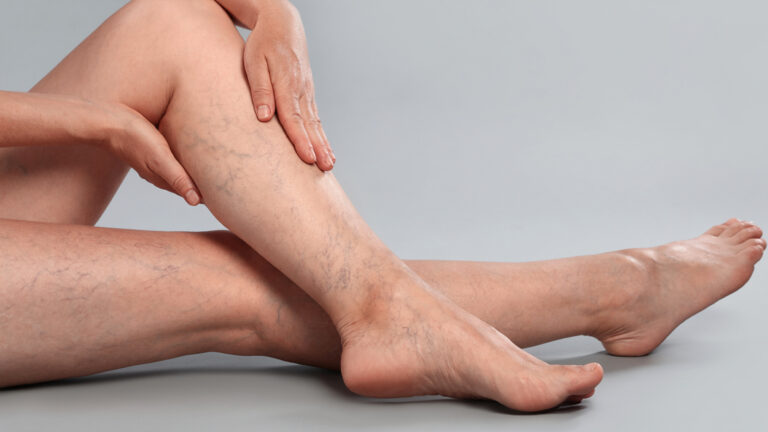 Varices en las piernas: qué son, por qué salen y cómo se tratan
